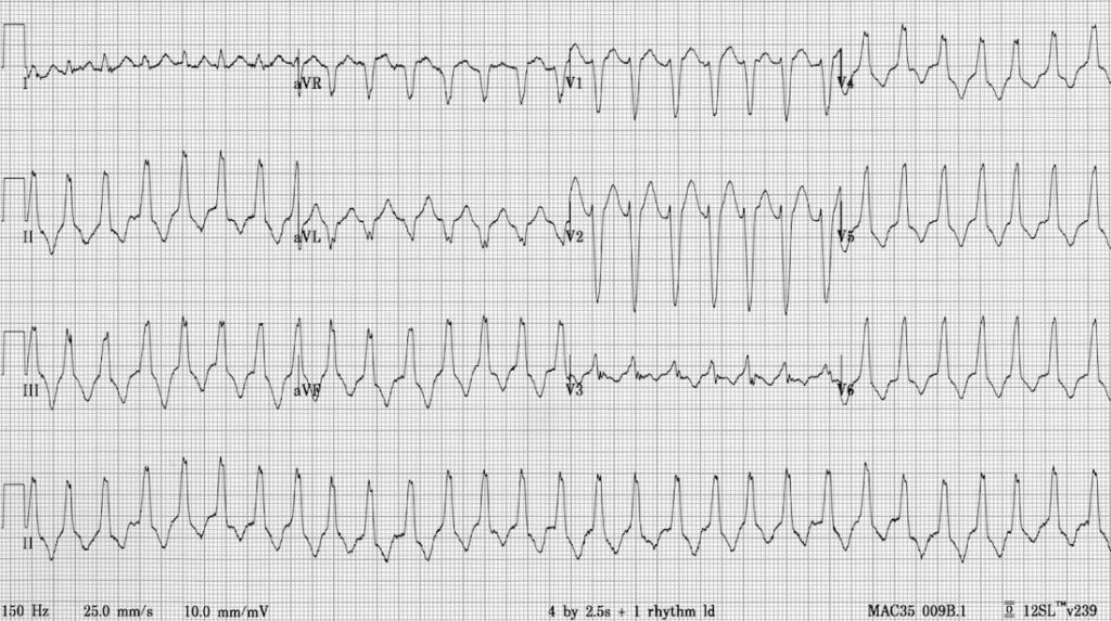 TOP 100 ECG QUIZ LITFL 048 2