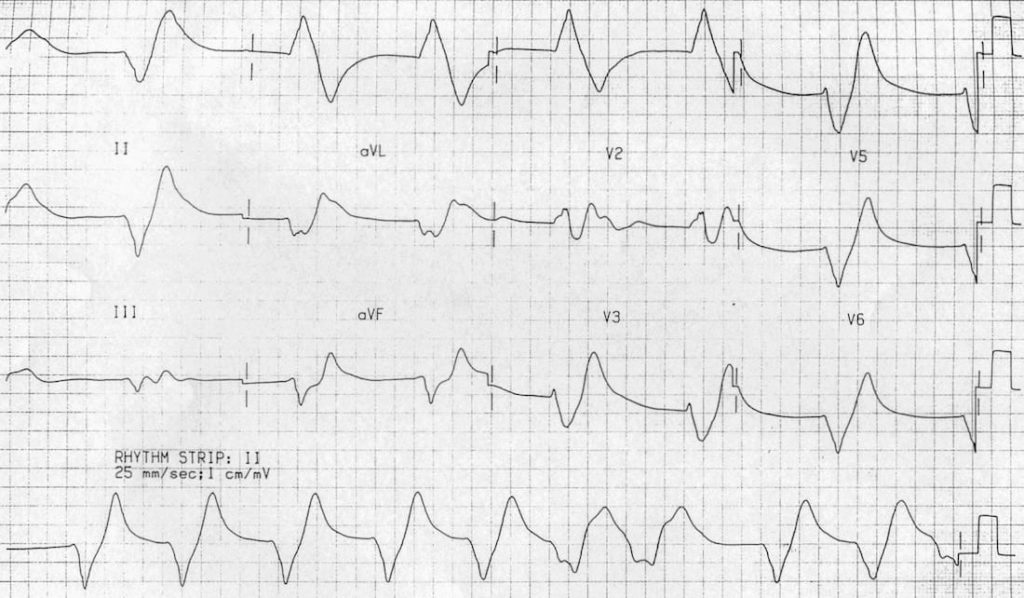 TOP 100 ECG QUIZ LITFL 050 2