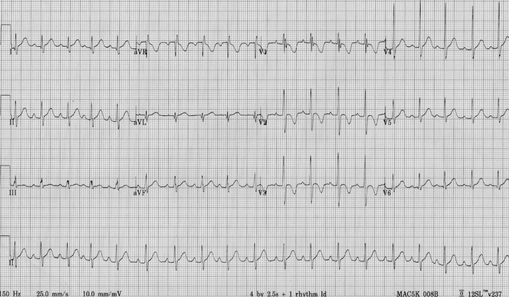 TOP 100 ECG QUIZ LITFL 051