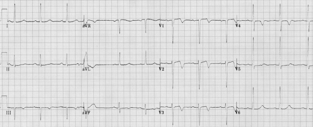 TOP 100 ECG QUIZ LITFL 052