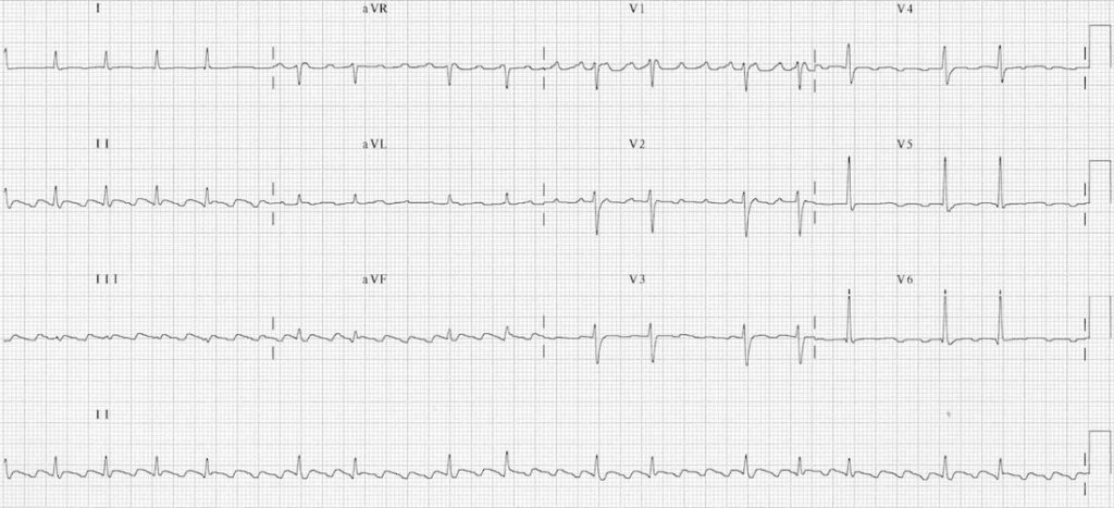 TOP 100 ECG QUIZ LITFL 053