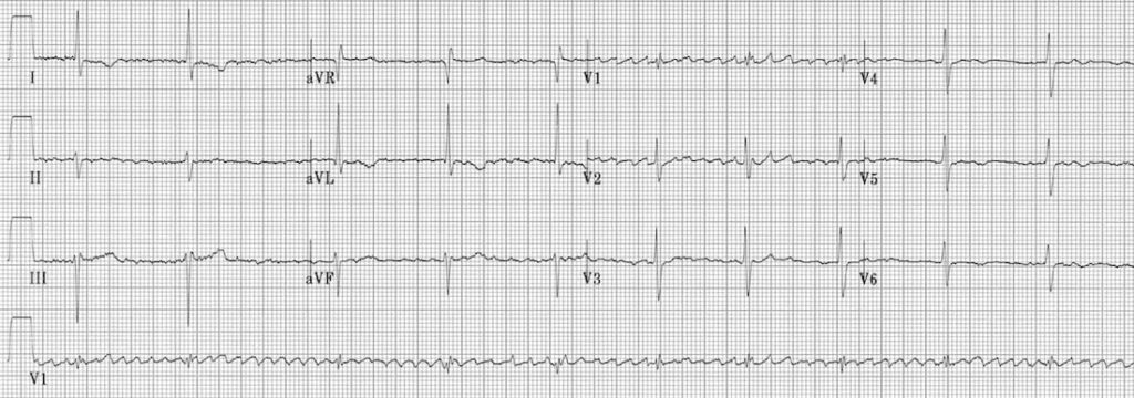 TOP 100 ECG QUIZ LITFL 054