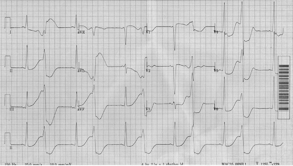 ECG Case 059 • LITFL • ECG Top 100 Self-Assessment Quiz