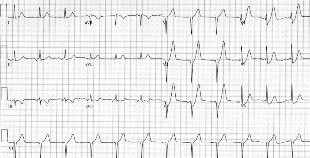 ECG Case 062 • LITFL • ECG Top 100 Self-Assessment Quiz