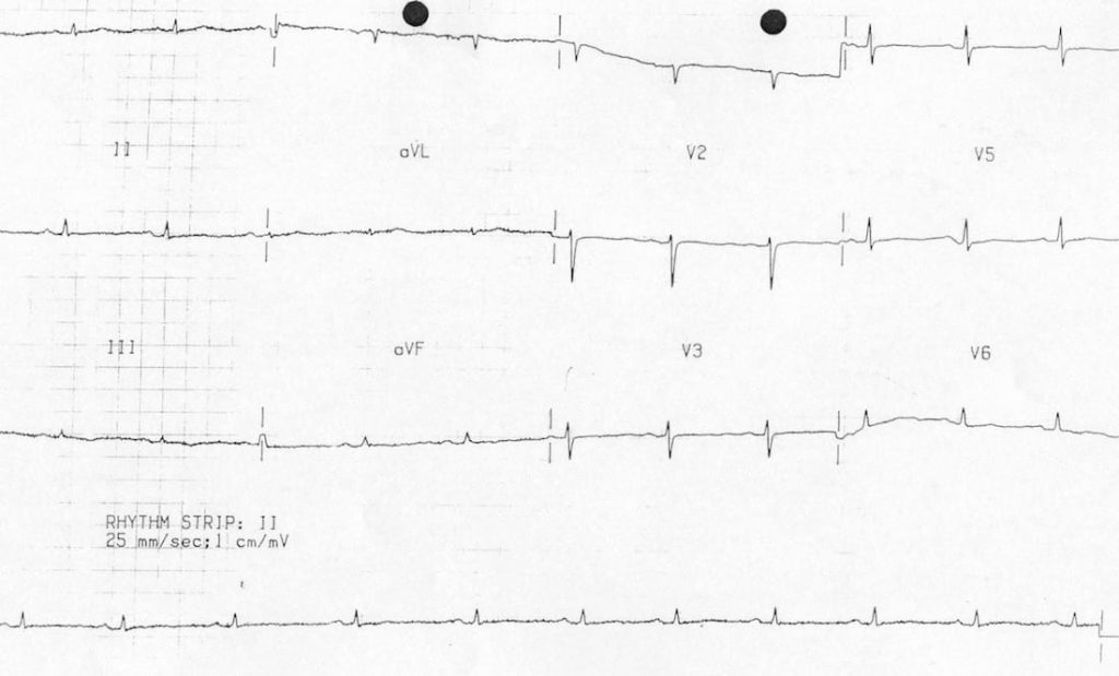 TOP 100 ECG QUIZ LITFL 063