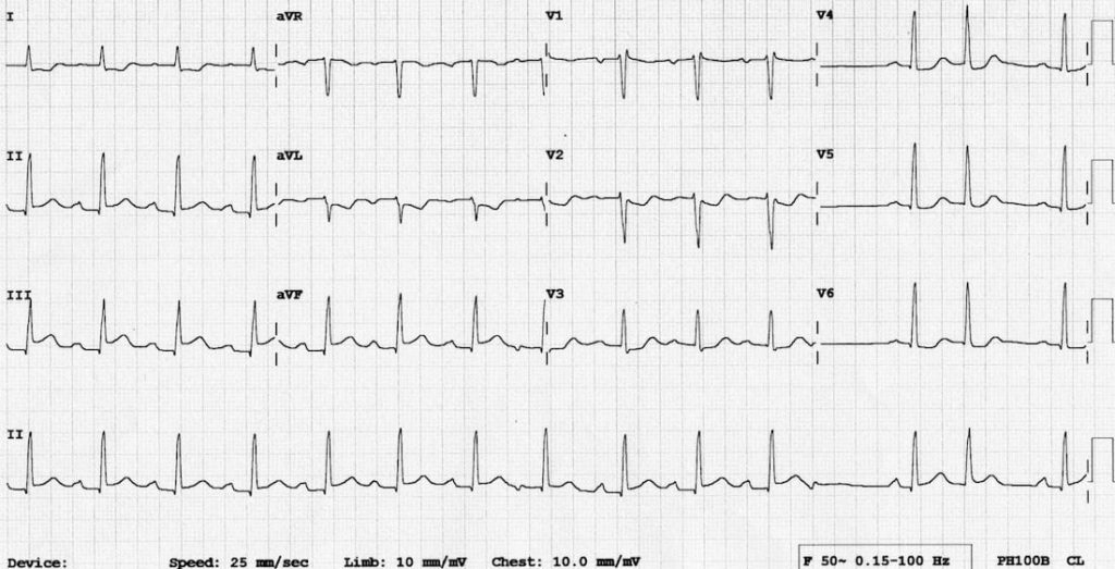 ECG Case 064 • LITFL • ECG Top 100 Self-Assessment Quiz