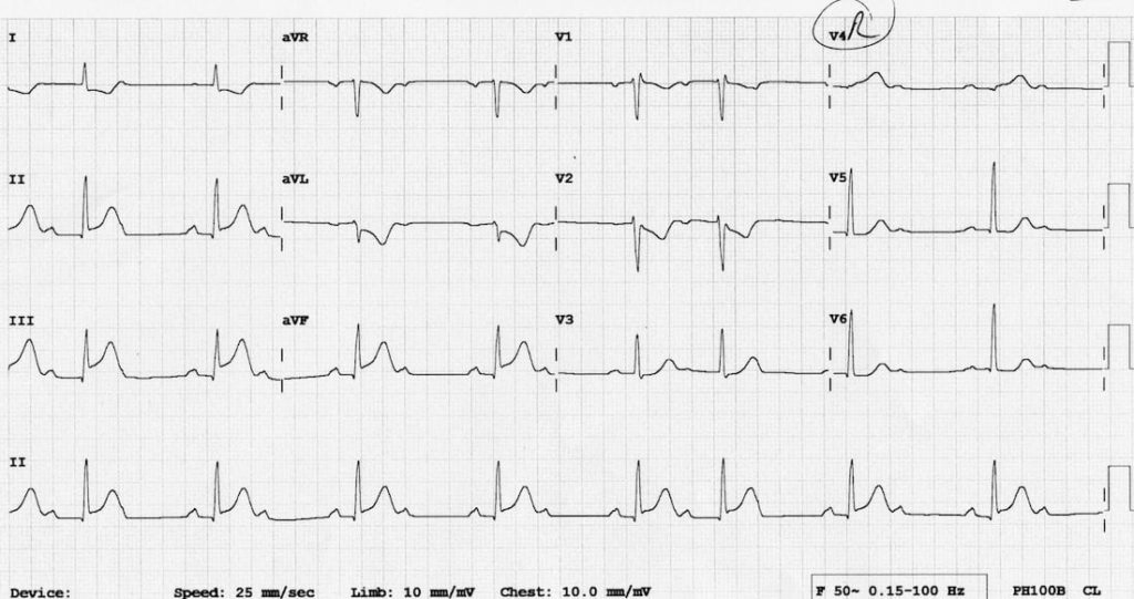 TOP 100 ECG QUIZ LITFL 065