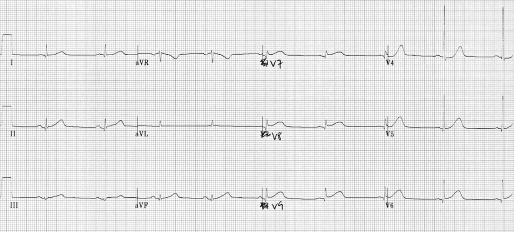 TOP 100 ECG QUIZ LITFL 067