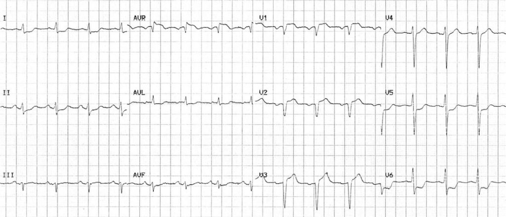 TOP 100 ECG QUIZ LITFL 068