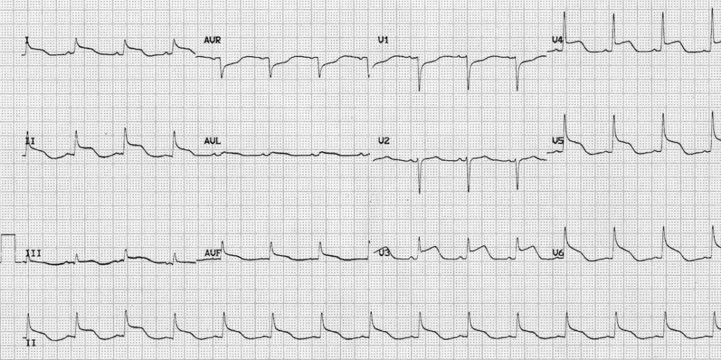 TOP 100 ECG QUIZ LITFL 069