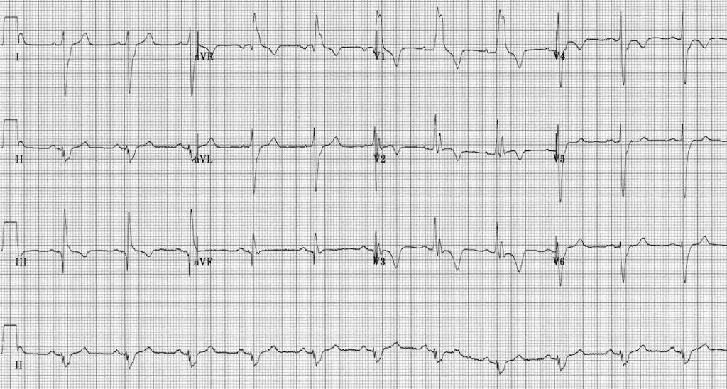 TOP 100 ECG QUIZ LITFL 070