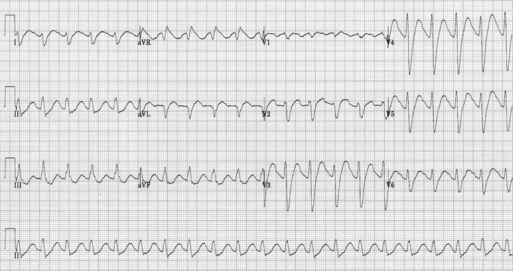 TOP 100 ECG QUIZ LITFL 004