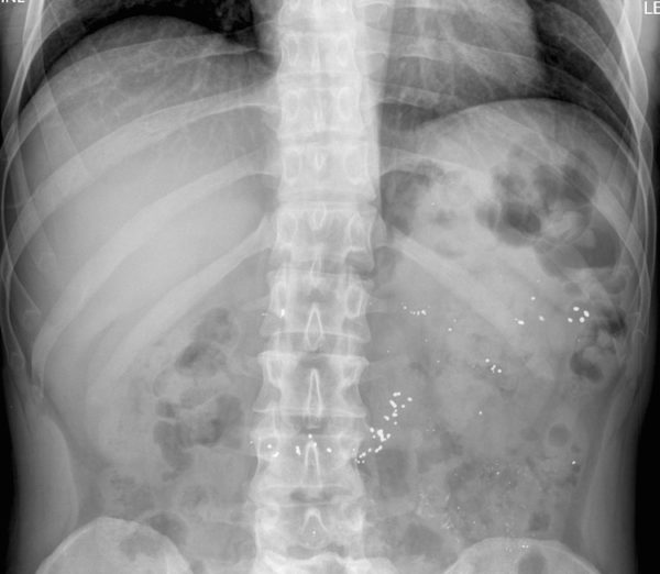 Tox Mercury ingestion LITFL