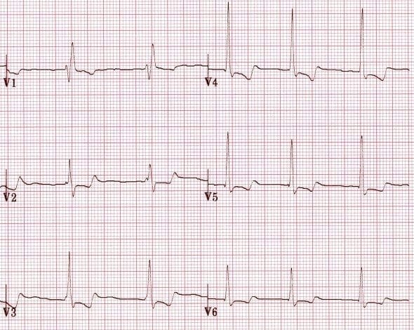 U Wave • LITFL Medical Blog • ECG Library Basics