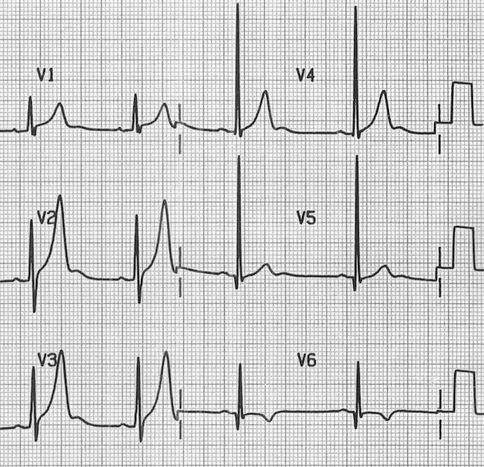 U Wave • LITFL Medical Blog • ECG Library Basics