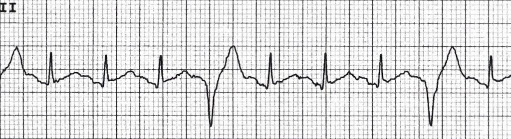 Ventricular Couplets