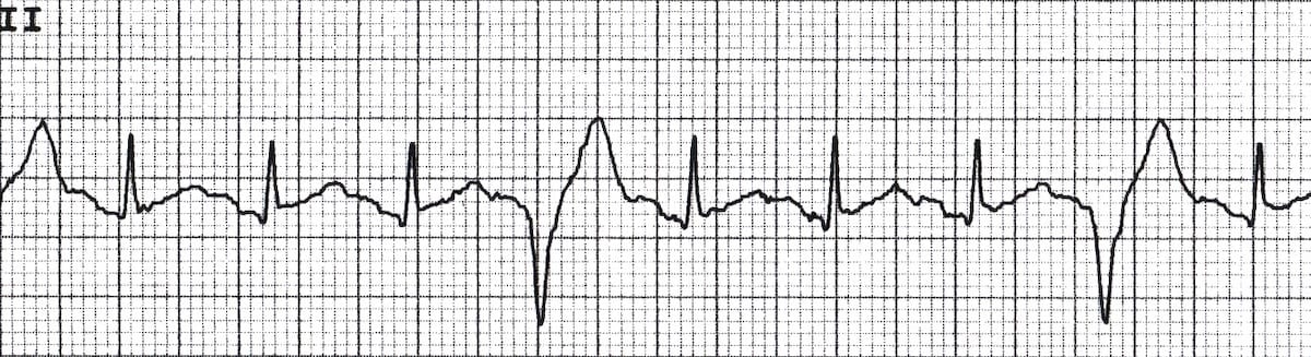 Ecg Premature Ventricular Complexes Pvc | The Best Porn Website