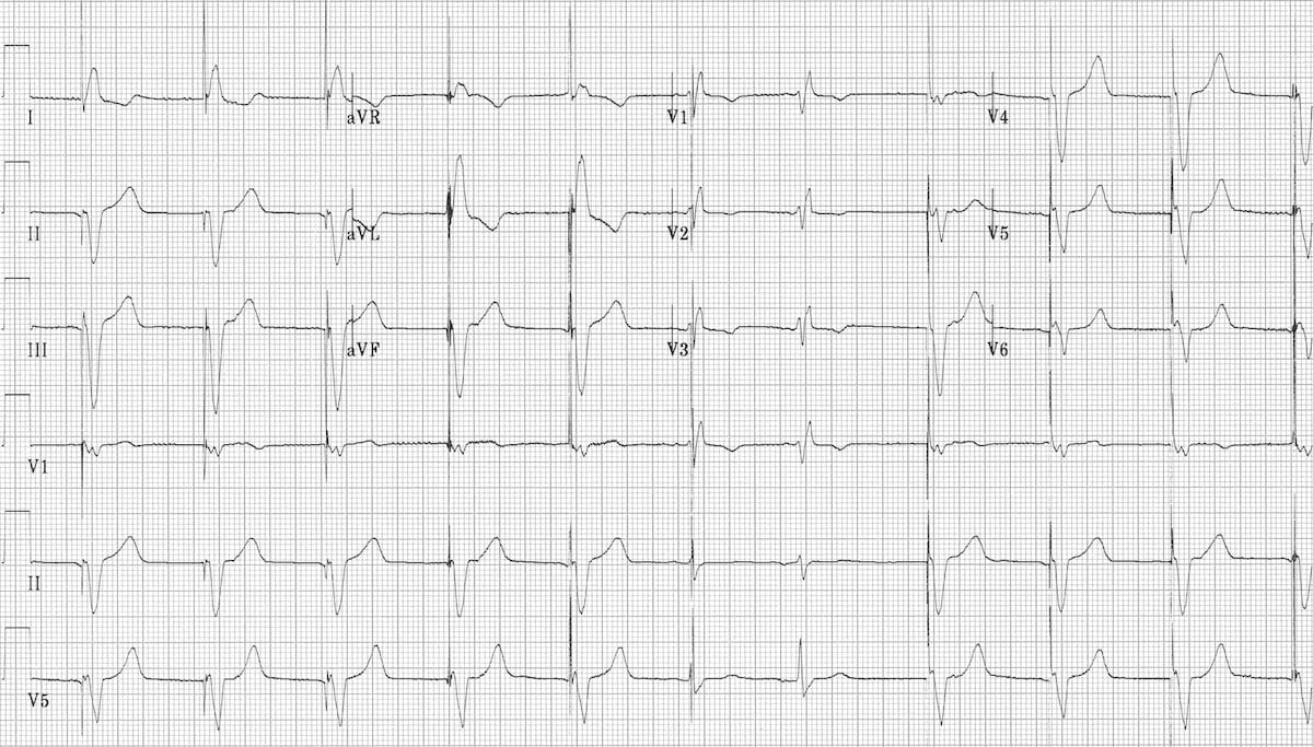 Pacemaker EKG Strip