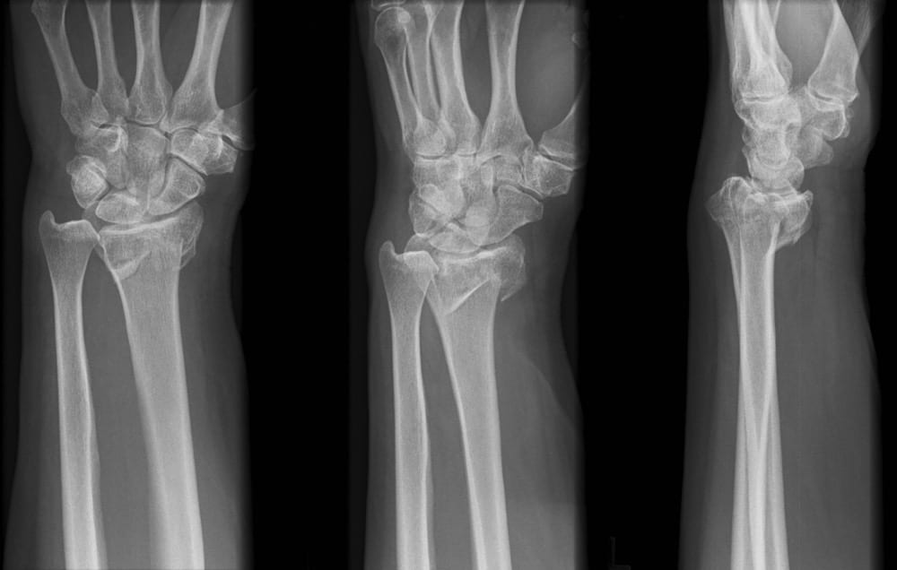 Volar barton fracture