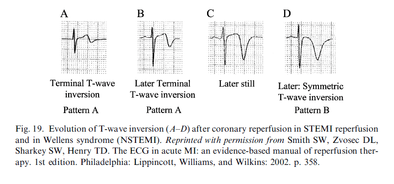 Myocardial Ischaemia LITFL ECG Library Diagnosis