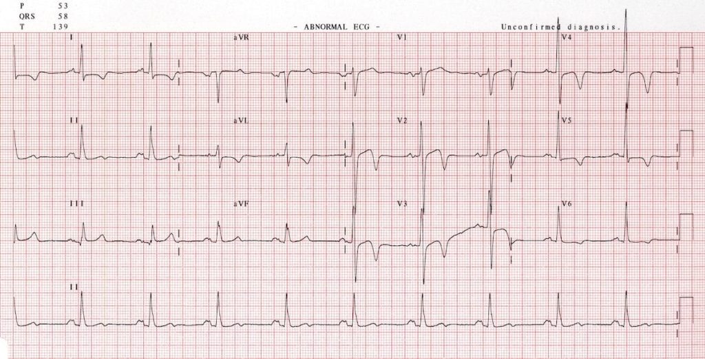 apical HCM 2