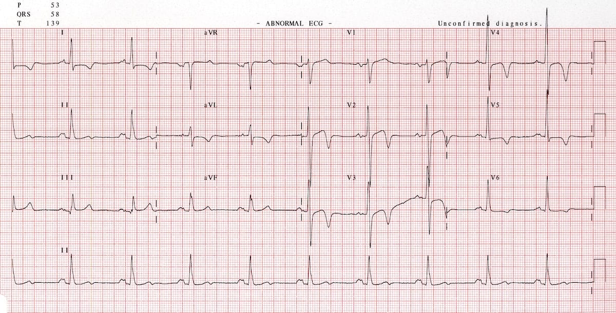 Apical Hypertrophic Cardiomyopathy Symptoms