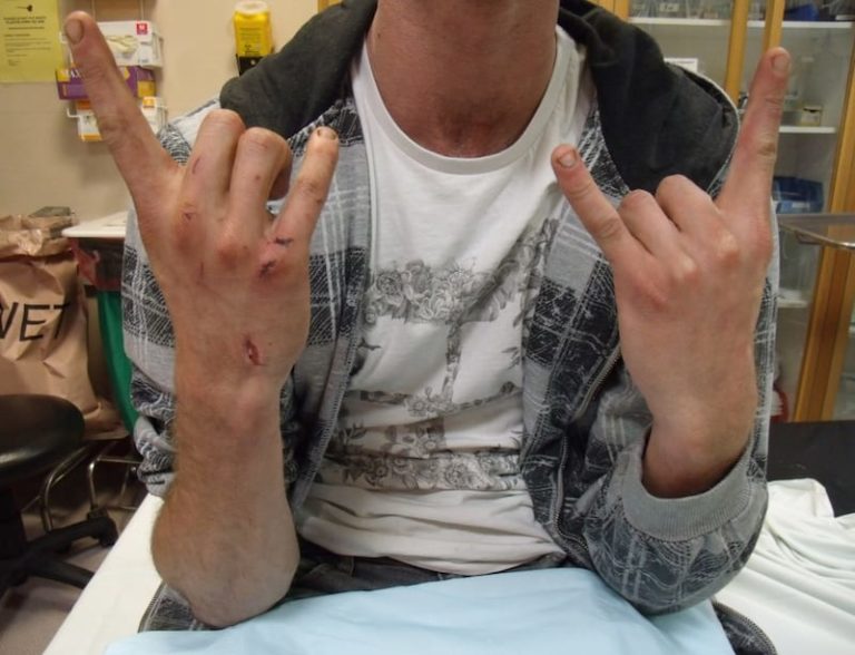 Devil's Horn Sign • LITFL • Clinical Cases Bamboozler