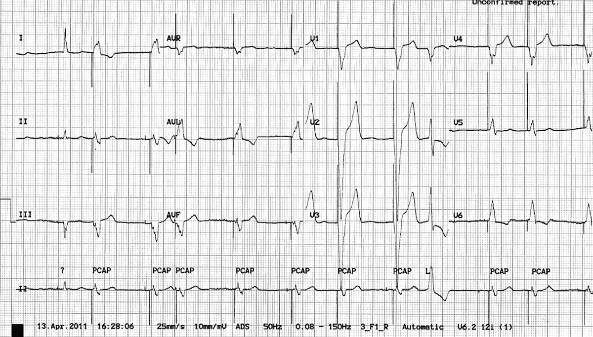 wandering atrial pacemaker rhythm strip