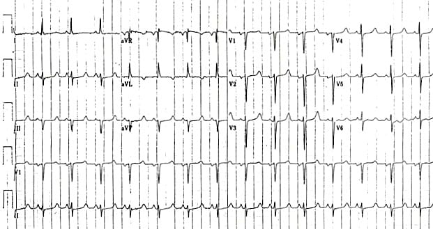 Hypocalcaemia ECG changes • LITFL • ECG Library