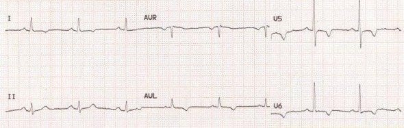 t-wave-litfl-ecg-library-basics