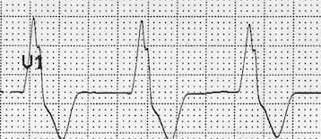 Accelerated Idioventricular Rhythm