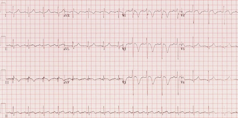 t-wave-litfl-ecg-library-basics