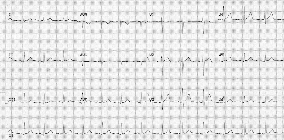 electrocardiograma normal