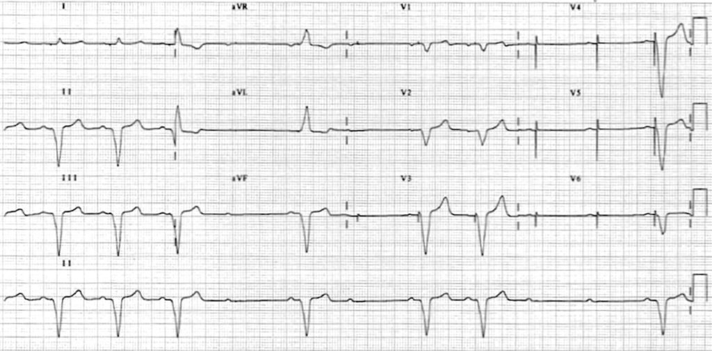 pacemaker failure to capture ekg