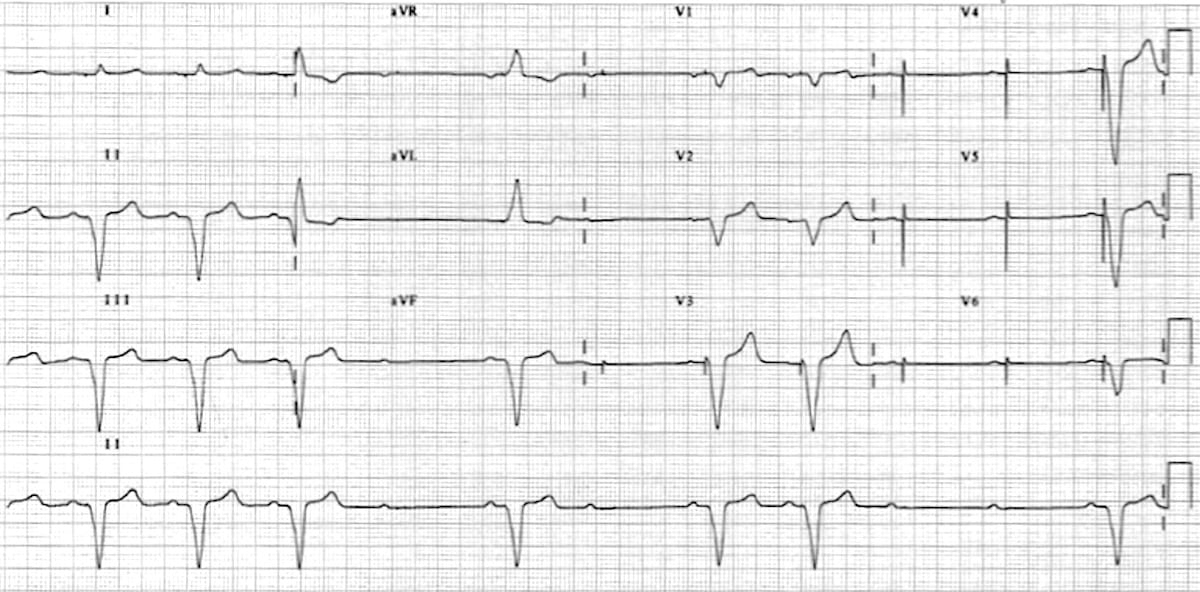 Pacemaker Failure To Capture