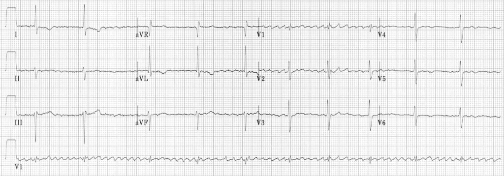 regularised atrial fibrillation ECG