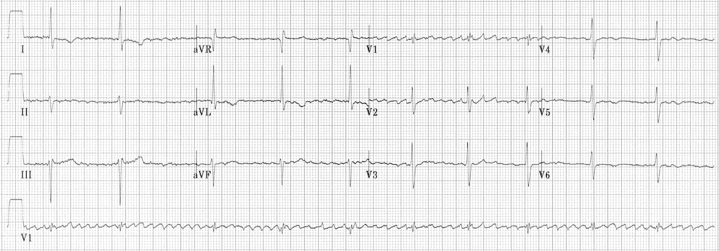 Junctional Escape Rhythm Litfl Ecg Library Diagnosis