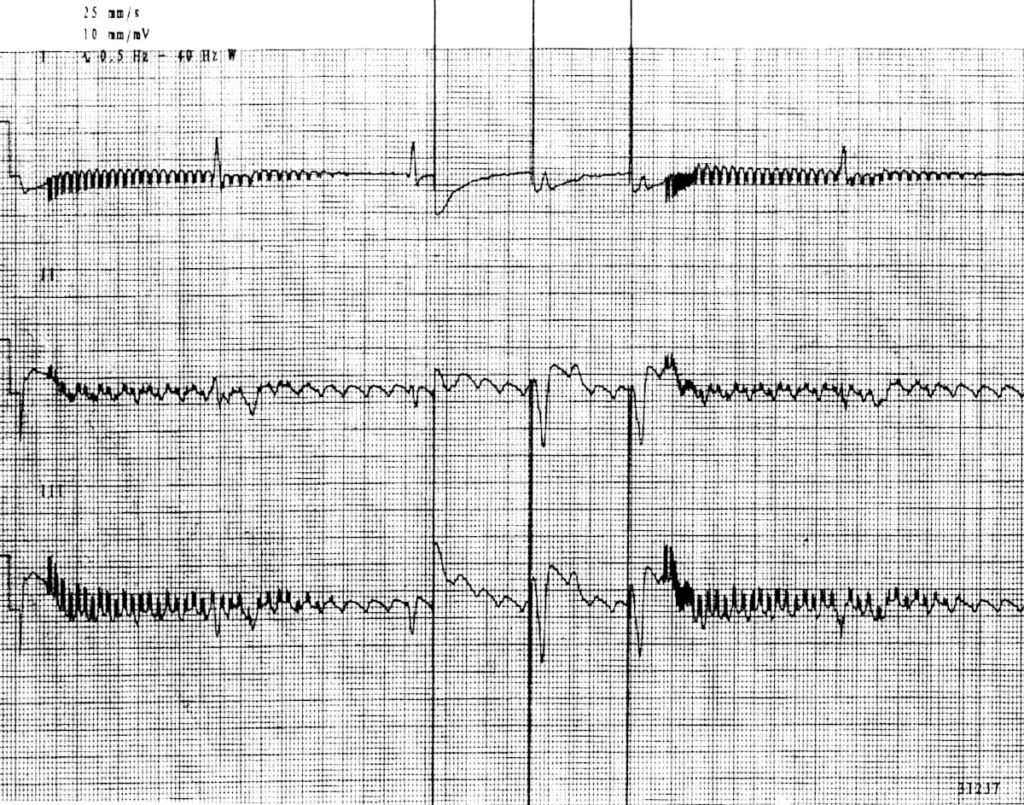 failure to capture ecg