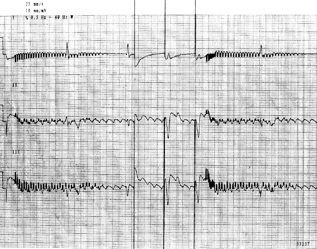 Arterial line and Pressure Transducer • LITFL • CCC Equipment