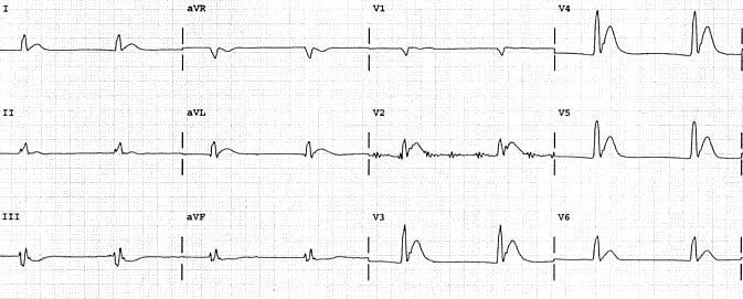 Electrocardiograma De Hipercalcemia