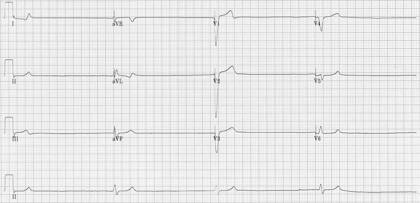 Ventricular Escape Rhythm LITFL ECG Library Diagnosis