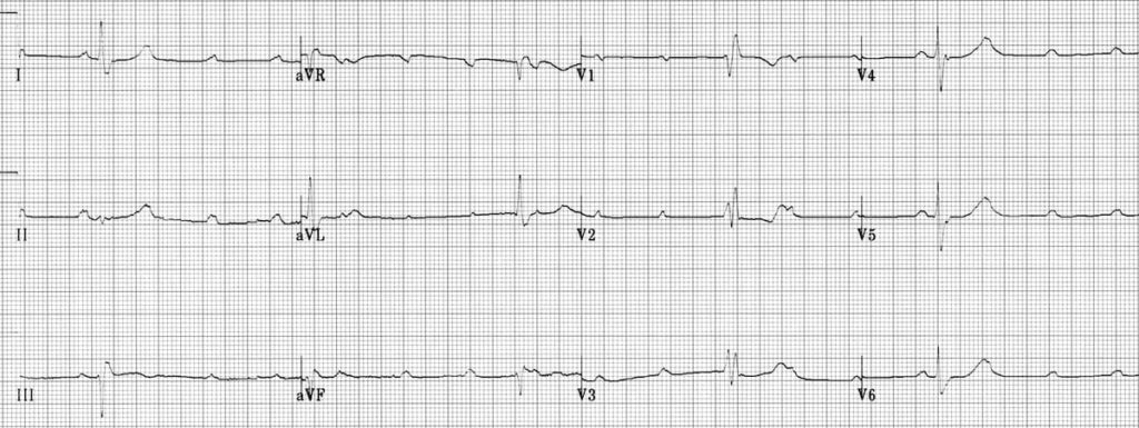 trifascicular-3 2