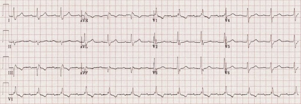 percent of ivcd vs rbbb crt