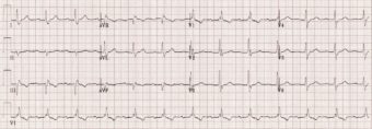 Trifascicular Block • LITFL • ECG Library Diagnosis