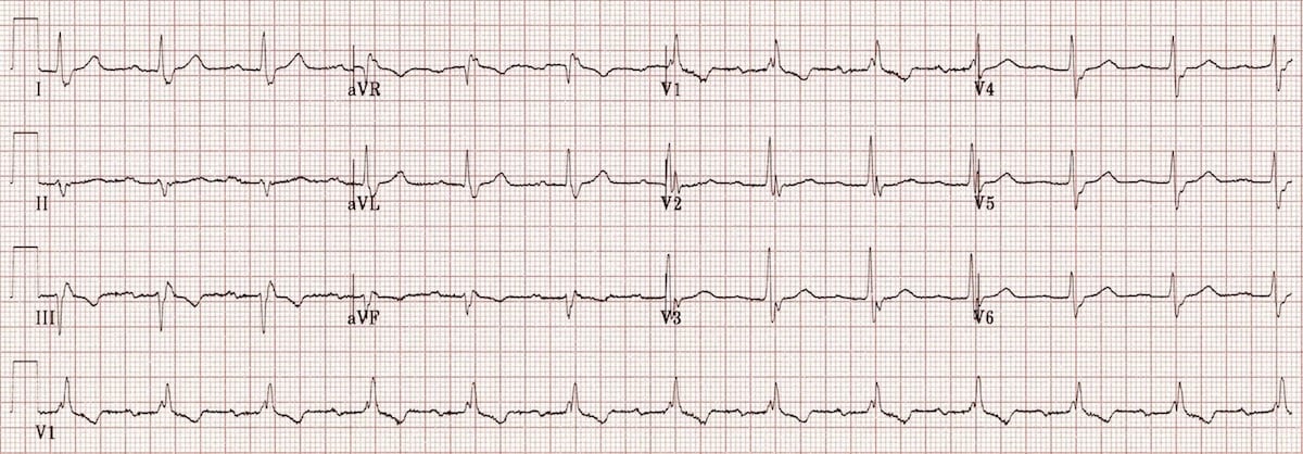 Trifascicular Block Litfl Ecg Library Diagnosis