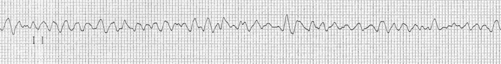 ventricular fibrillation rhythm strip VF