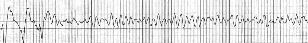 ventricular fibrillation rhythm strip VF shock advised