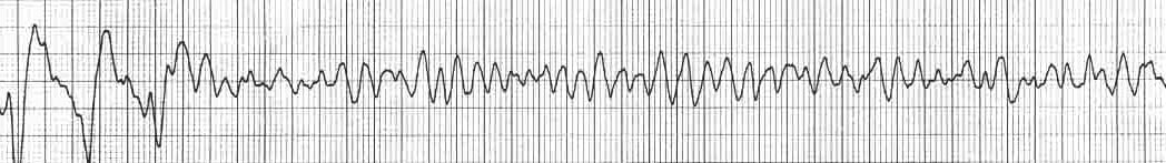 fine ventricular fibrillation vs coarse ventricular fibrillation