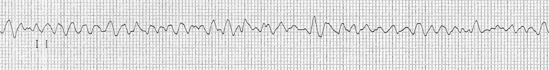 fine ventricular fibrillation vs coarse ventricular fibrillation