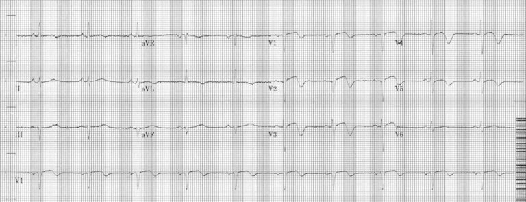 Wellens Syndrome • LITFL • ECG Library Eponym